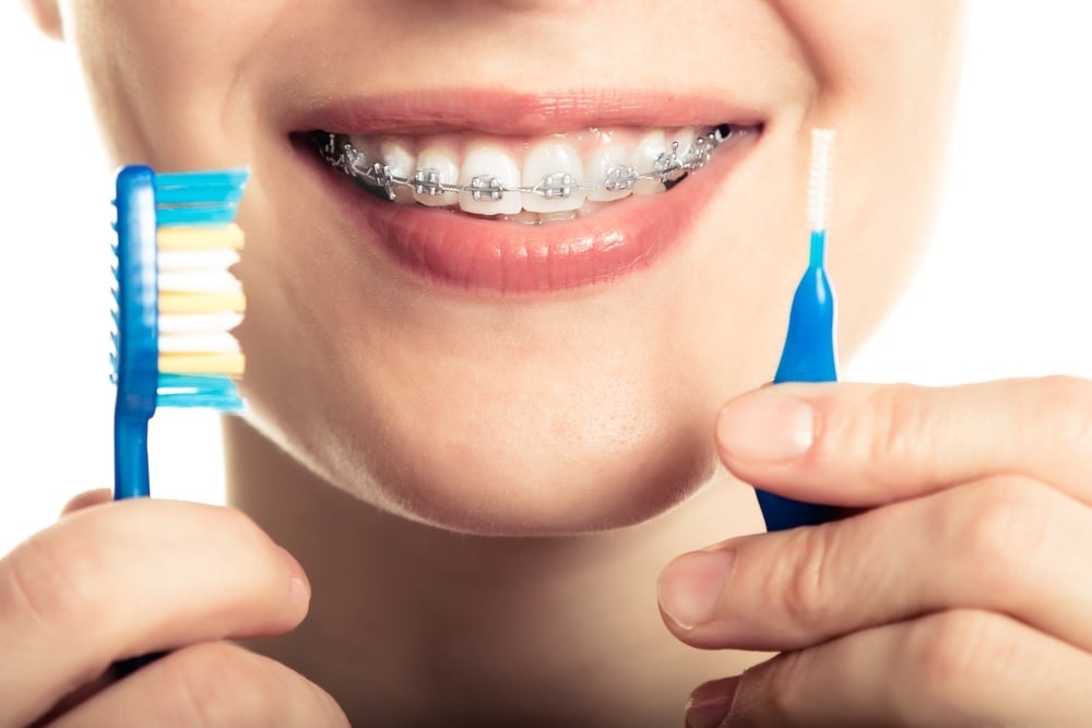 Tips to keep your braces clean